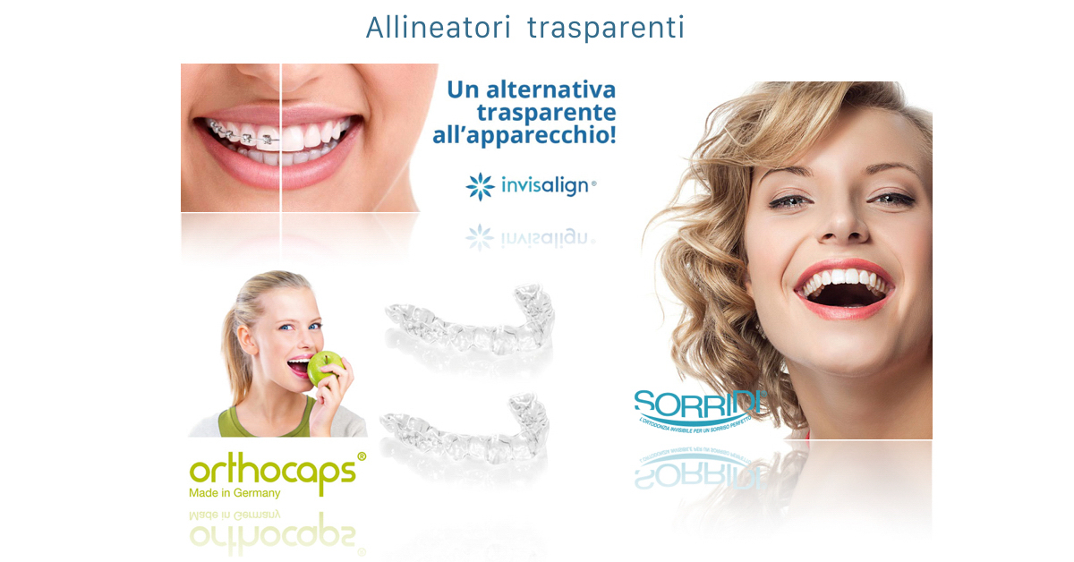 Apparecchi ortodontici - allineatori invisibili
