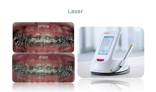 Apparecchi ortodontici - laser