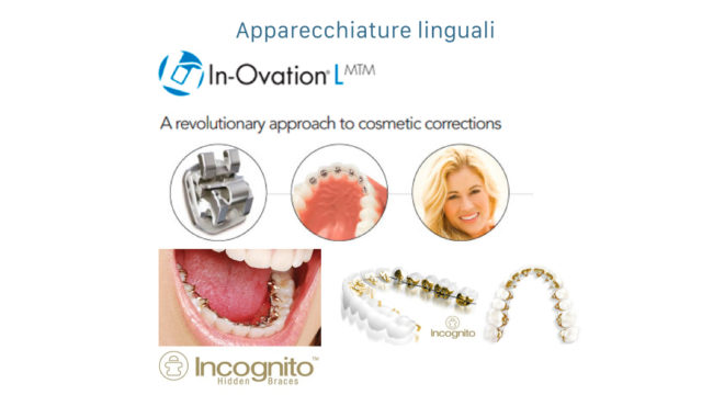 Apparecchi ortodontici - linguali