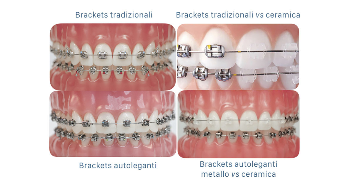 apparecchi ortodontici - brackets