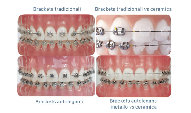 apparecchi ortodontici - brackets